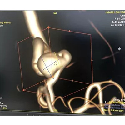 Anyuan County的活肿块切除术